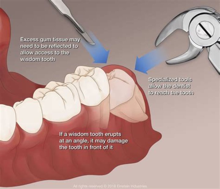 How can I get my teeth pulled for free?
