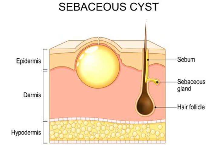 How do you get rid of a cyst sac at home?