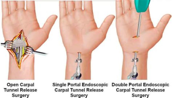 How much compensation will I get for carpal tunnel?
