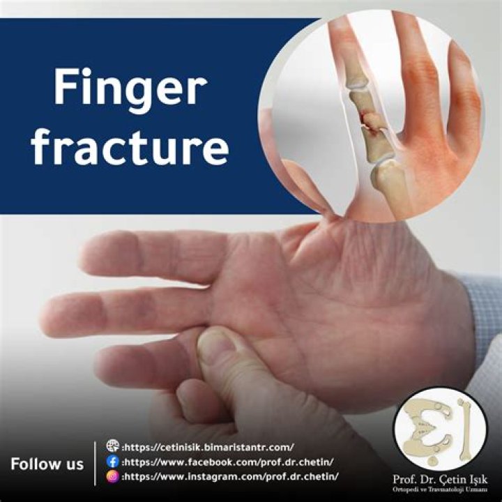 How much is a broken finger worth in compensation?