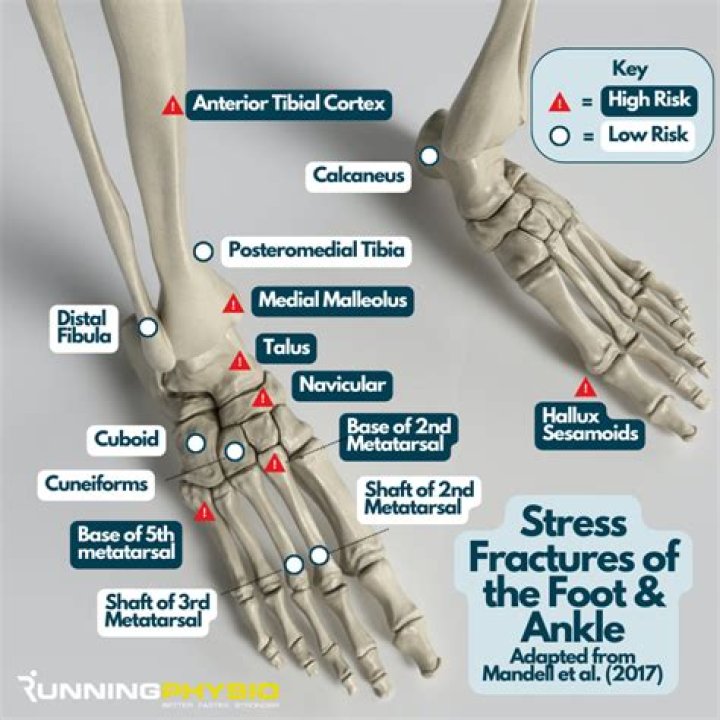 How much is a broken foot injury worth?