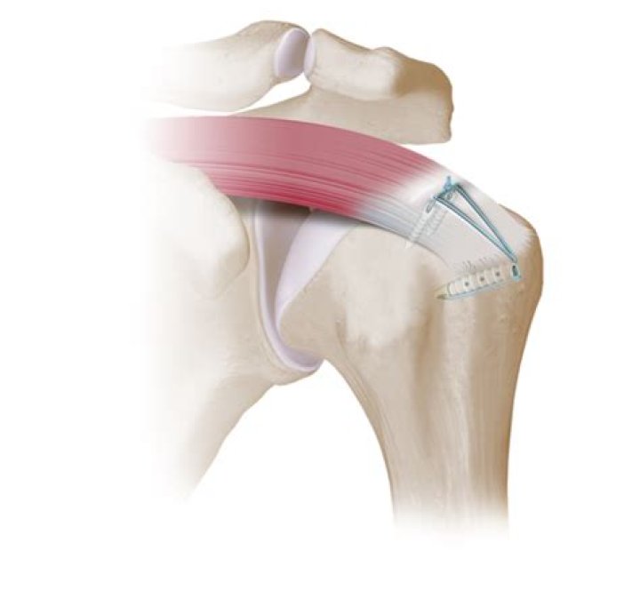 How much is a shoulder surgery settlement worth?