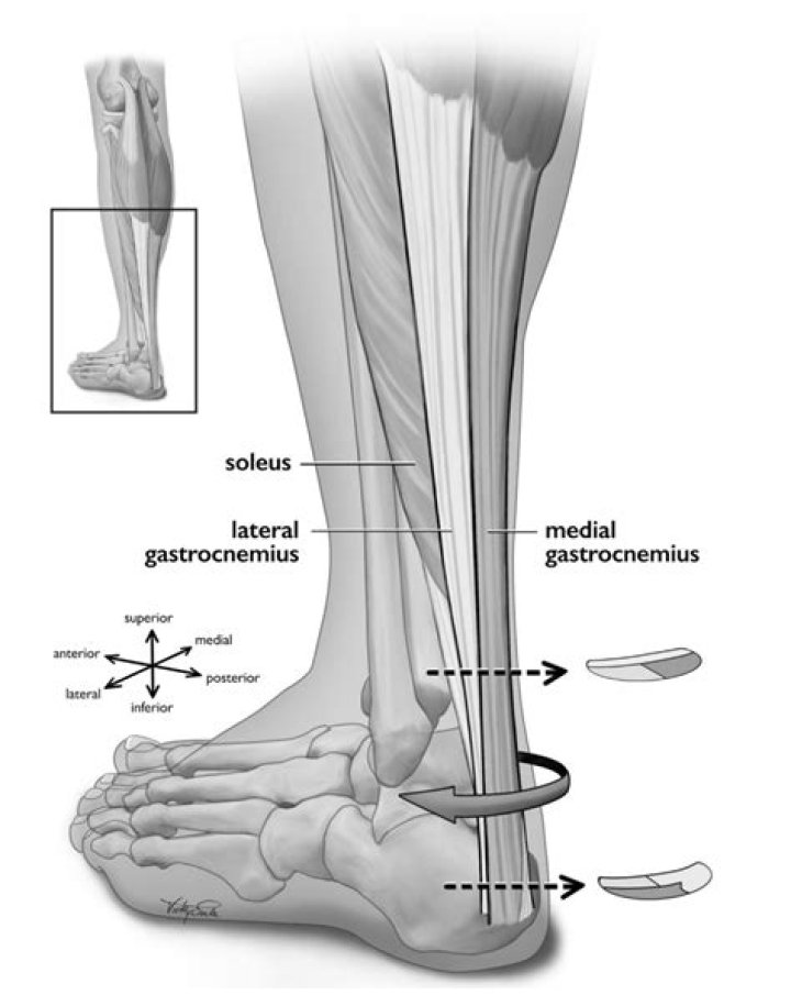 How much is an Achilles tendon worth?