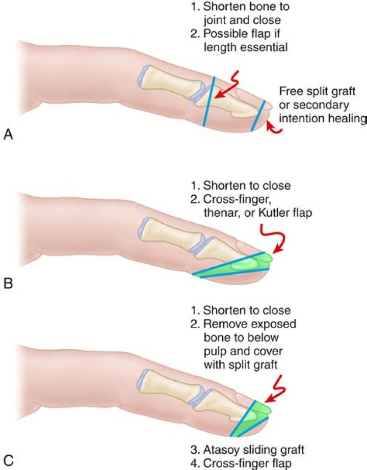 How much is an amputated toe worth?