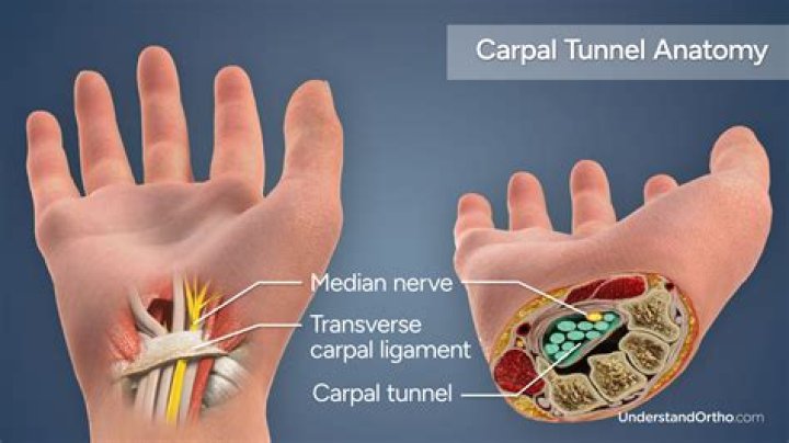 Is carpal tunnel a disability in California?