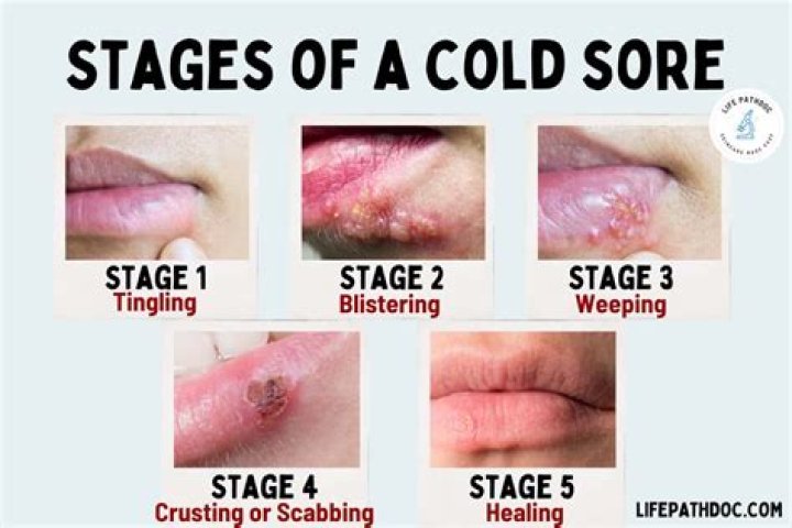 Is herpes still contagious after 20 years?