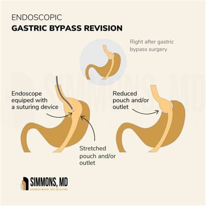 Is it hard to get approved for gastric bypass?