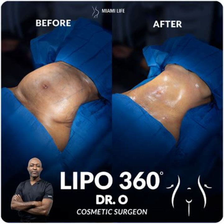 Is liposuction covered by private health insurance?