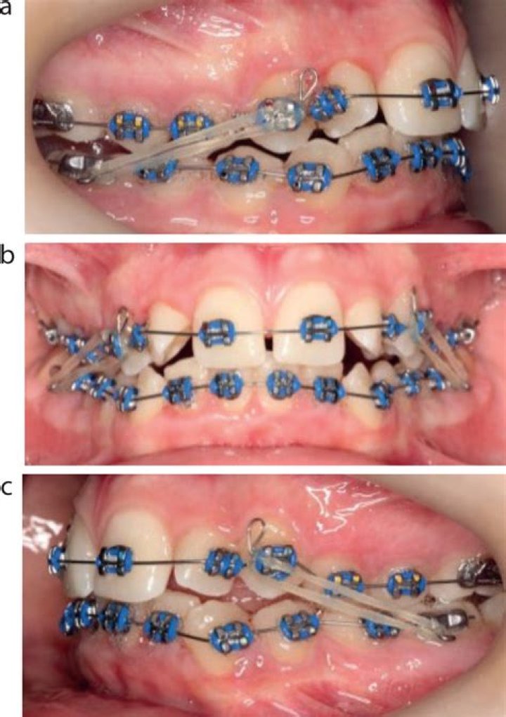 Is orthodontia covered?