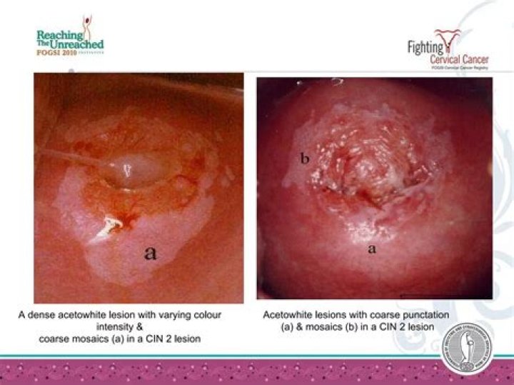 Should I be worried if I need a colposcopy?