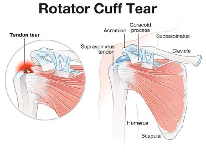 What happens if a rotator cuff injury goes untreated?