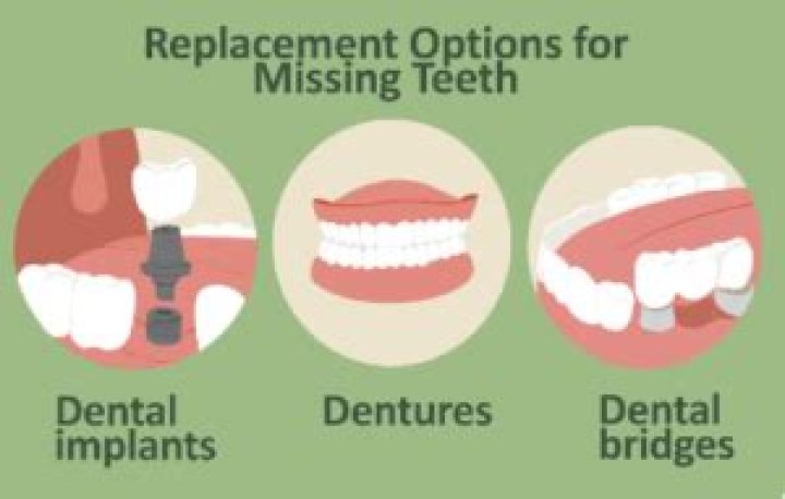 What is the dental code for a partial?